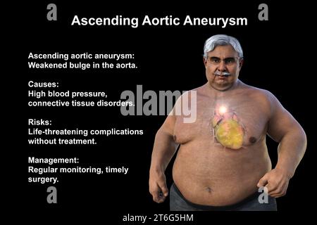 Wissenschaftliche 3D-Illustration, die einen älteren adipösen Mann mit transparenter Haut zeigt und ein aufsteigendes Aortenaneurysma zeigt, ein Konzept, das den Asso unterstreicht Stockfoto