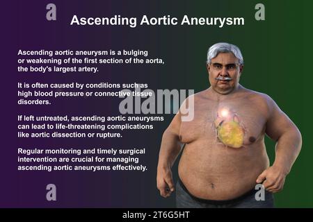 Wissenschaftliche 3D-Illustration, die einen älteren adipösen Mann mit transparenter Haut zeigt und ein aufsteigendes Aortenaneurysma zeigt, ein Konzept, das den Asso unterstreicht Stockfoto