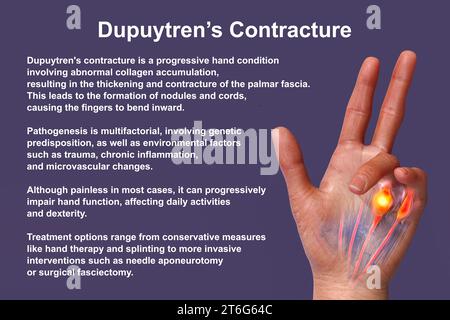 Eine medizinische 3D-Illustration, die die Hand eines Patienten mit Dupuytren-Kontraktur zeigt, wobei die betroffenen Sehnen und die Palmarfaszie hervorgehoben werden, um t zu veranschaulichen Stockfoto