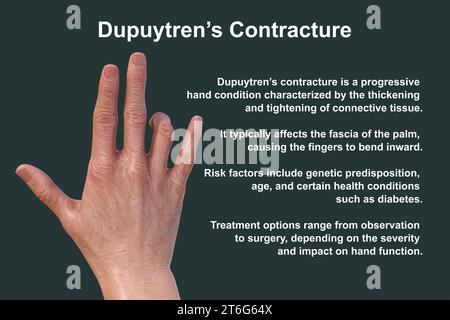 Hand eines Patienten mit Dupuytren'scher Kontraktur, einer Erkrankung, die dazu führt, dass sich die Finger zur Handfläche beugen, fotorealistische 3D-Illustration Stockfoto