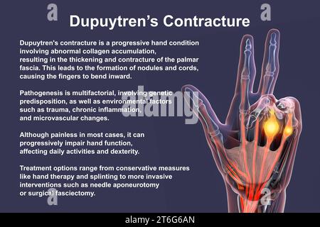 Eine medizinische 3D-Illustration, die die Hand eines Patienten mit Dupuytren-Kontraktur zeigt, wobei die betroffenen Sehnen und die Palmarfaszie hervorgehoben werden, um t zu veranschaulichen Stockfoto