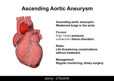 Ein menschliches Herz mit einem aufsteigenden Aortenaneurysma, 3D-Illustration, die die Dilatation und mögliche Gesundheitsrisiken im Zusammenhang mit der Erkrankung betont Stockfoto