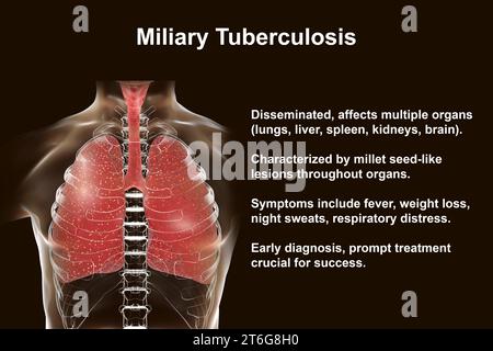 Eine detaillierte fotorealistische 3D-Illustration, die menschliche Lunge zeigt, die von Miliary Tuberkulose betroffen ist Stockfoto