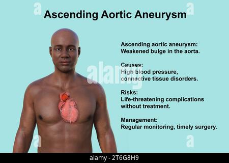 Eine 3D-fotorealistische Darstellung des oberen Halbteils eines afrikanischen Mannes mit transparenter Haut, die ein aufsteigendes Aortenaneurysma offenbart Stockfoto