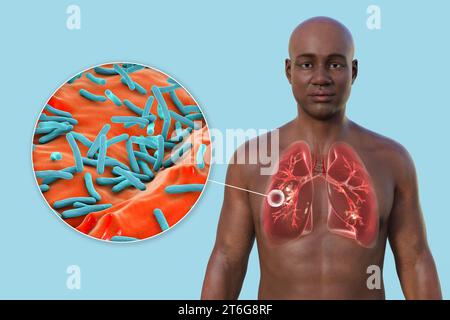 Eine fotorealistische 3D-Illustration der oberen Hälfte eines Mannes mit transparenter Haut, zeigt die Lungen, die von kavernöser Tuberkulose betroffen sind, und... Stockfoto