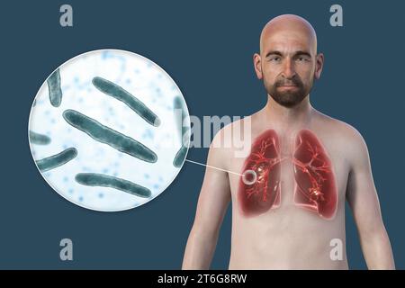 Eine fotorealistische 3D-Illustration der oberen Hälfte eines Mannes mit transparenter Haut, die die Lungen zeigt, die von kavernöser Tuberkulose und Close-u betroffen sind Stockfoto