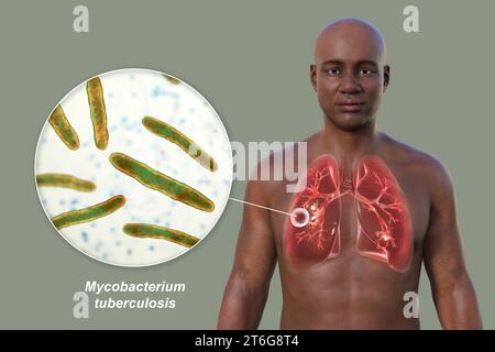 Eine fotorealistische 3D-Illustration der oberen Hälfte eines Mannes mit transparenter Haut, zeigt die Lungen, die von kavernöser Tuberkulose betroffen sind, und... Stockfoto