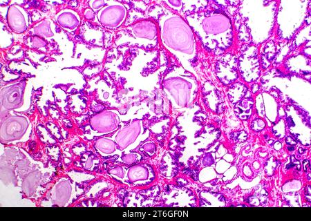 Mikrografie der Prostatahyperplasie mit erhöhtem Drüsengewebe. Stockfoto