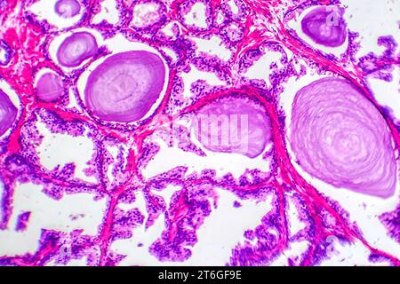 Mikrografie der Prostatahyperplasie mit erhöhtem Drüsengewebe. Stockfoto