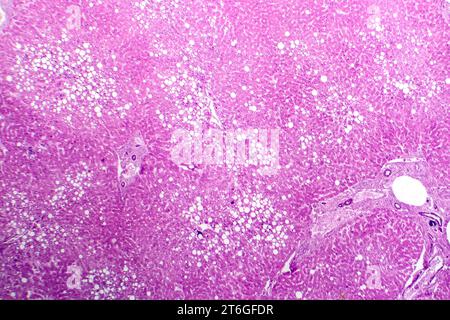 Photomikrograph der Lebersteatose, die Fettansammlung in Leberzellen, bekannt als Fettleberkrankheit, aufdeckt. Stockfoto