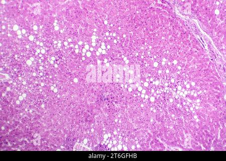 Photomikrograph der Lebersteatose, die Fettansammlung in Leberzellen, bekannt als Fettleberkrankheit, aufdeckt. Stockfoto