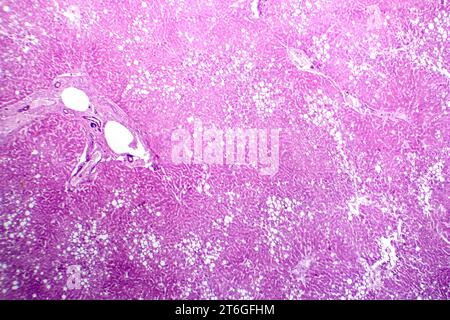 Photomikrograph der Lebersteatose, die Fettansammlung in Leberzellen, bekannt als Fettleberkrankheit, aufdeckt. Stockfoto