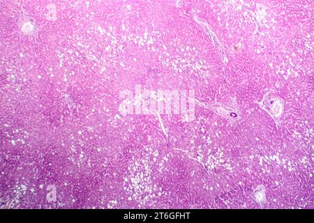 Photomikrograph der Lebersteatose, die Fettansammlung in Leberzellen, bekannt als Fettleberkrankheit, aufdeckt. Stockfoto
