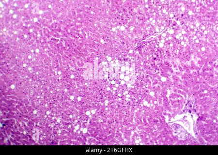 Photomikrograph der Lebersteatose, die Fettansammlung in Leberzellen, bekannt als Fettleberkrankheit, aufdeckt. Stockfoto