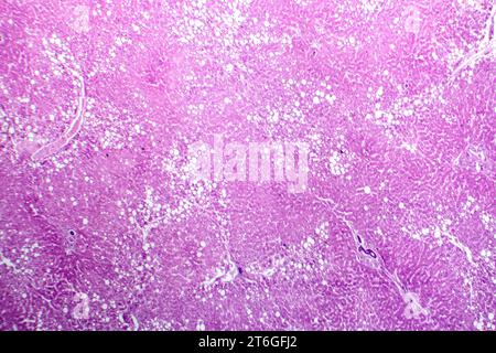 Photomikrograph der Lebersteatose, die Fettansammlung in Leberzellen, bekannt als Fettleberkrankheit, aufdeckt. Stockfoto