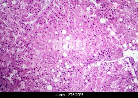 Photomikrograph der Lebersteatose, die Fettansammlung in Leberzellen, bekannt als Fettleberkrankheit, aufdeckt. Stockfoto