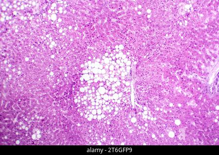 Photomikrograph der Lebersteatose, die Fettansammlung in Leberzellen, bekannt als Fettleberkrankheit, aufdeckt. Stockfoto