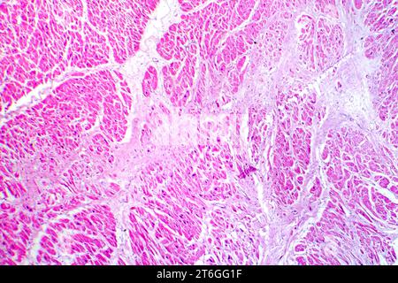Photomikrographie des Myokardinfarkts, Darstellung von beschädigtem Herzgewebe durch verminderte Blutversorgung und Zelltod. Stockfoto