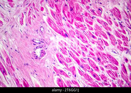 Photomikrographie des Myokardinfarkts, Darstellung von beschädigtem Herzgewebe durch verminderte Blutversorgung und Zelltod. Stockfoto