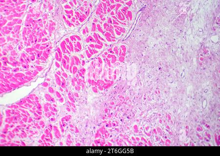 Photomikrographie des Myokardinfarkts, Darstellung von beschädigtem Herzgewebe durch verminderte Blutversorgung und Zelltod. Stockfoto