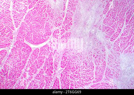 Photomikrographie des Myokardinfarkts, Darstellung von beschädigtem Herzgewebe durch verminderte Blutversorgung und Zelltod. Stockfoto