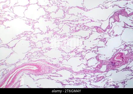 Photomikrographie des diffusen Emphysems, die bei chronisch obstruktiver Lungenerkrankung charakteristisch für das geschädigte Lungengewebe mit vergrößerten Lufträumen zeigt ( Stockfoto