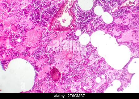 Photomikrographie der lobären Pneumonie während der hämorrhagischen Odemperiode, Darstellung der Lungengewebsentzündung mit hämorrhagischen Veränderungen. Stockfoto