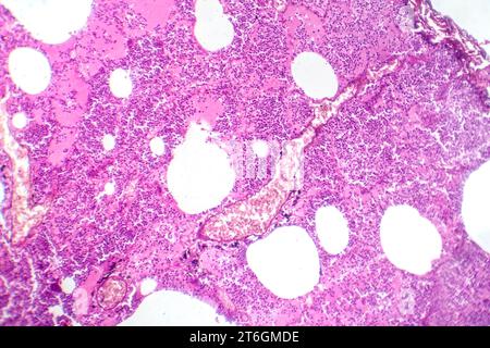 Photomikrographie der lobären Pneumonie während der hämorrhagischen Odemperiode, Darstellung der Lungengewebsentzündung mit hämorrhagischen Veränderungen. Stockfoto