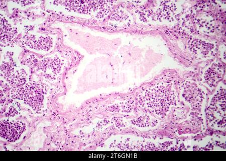 Photomikrographie der lobären Pneumonie in der grauen Leberphase, die den Lungengewebeübergang mit exsudatgefüllten Alveolen zeigt. Stockfoto