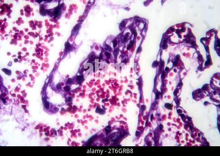Photomikrographie der Raucherlunge, Aufschluss über charakteristische Veränderungen und Schäden bei Langzeitrauchgewohnheiten. Stockfoto