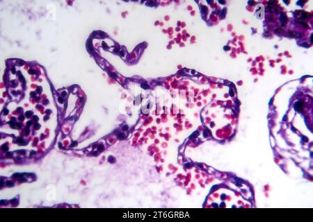 Photomikrographie der Raucherlunge, Aufschluss über charakteristische Veränderungen und Schäden bei Langzeitrauchgewohnheiten. Stockfoto
