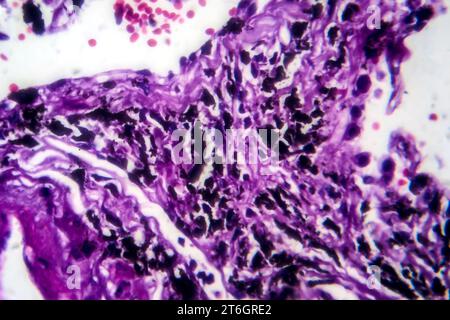 Photomikrographie der Raucherlunge, Aufschluss über charakteristische Veränderungen und Schäden bei Langzeitrauchgewohnheiten. Stockfoto
