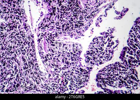 Photomikrographie der Raucherlunge, Aufschluss über charakteristische Veränderungen und Schäden bei Langzeitrauchgewohnheiten. Stockfoto