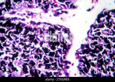 Photomikrographie der Raucherlunge, Aufschluss über charakteristische Veränderungen und Schäden bei Langzeitrauchgewohnheiten. Stockfoto