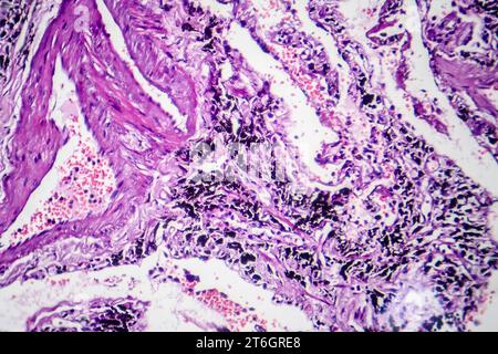 Photomikrographie der Raucherlunge, Aufschluss über charakteristische Veränderungen und Schäden bei Langzeitrauchgewohnheiten. Stockfoto