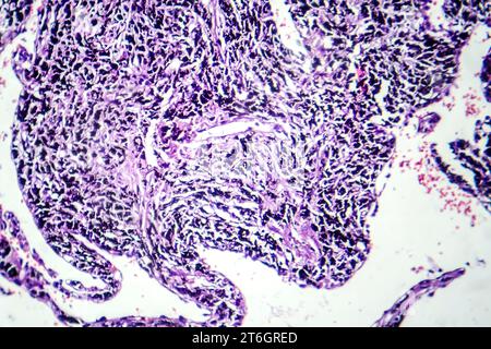 Photomikrographie der Raucherlunge, Aufschluss über charakteristische Veränderungen und Schäden bei Langzeitrauchgewohnheiten. Stockfoto