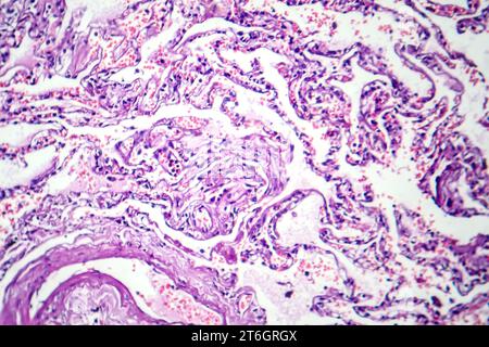 Photomikrographie der Raucherlunge, Aufschluss über charakteristische Veränderungen und Schäden bei Langzeitrauchgewohnheiten. Stockfoto