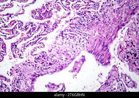 Photomikrographie der Raucherlunge, Aufschluss über charakteristische Veränderungen und Schäden bei Langzeitrauchgewohnheiten. Stockfoto
