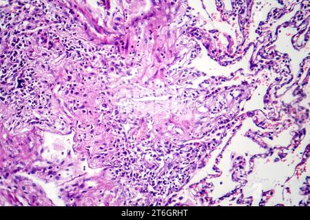 Photomikrographie der Raucherlunge, Aufschluss über charakteristische Veränderungen und Schäden bei Langzeitrauchgewohnheiten. Stockfoto