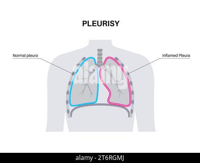Pleuritis, Illustration Stockfoto