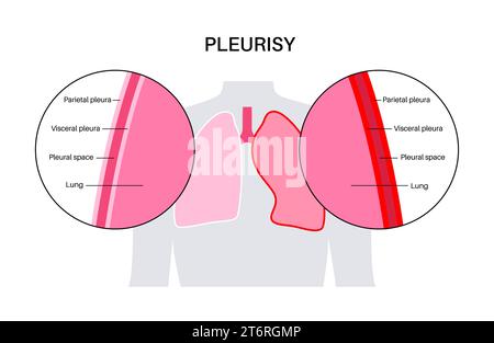 Pleuritis, Illustration Stockfoto