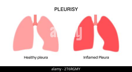 Pleuritis, Illustration Stockfoto