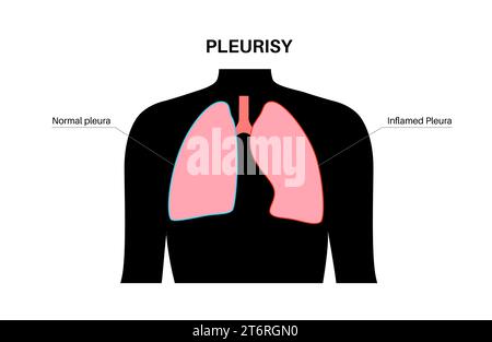 Pleuritis, Illustration Stockfoto