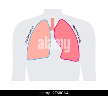 Pleuritis, Illustration Stockfoto