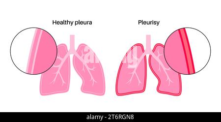 Pleuritis, Illustration Stockfoto