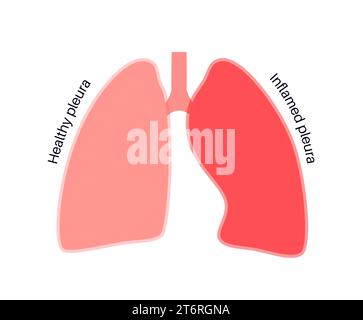Pleuritis, Illustration Stockfoto