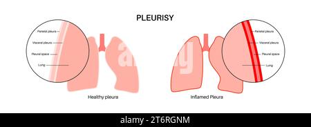 Pleuritis, Illustration Stockfoto