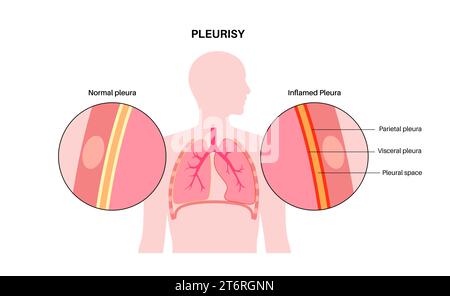 Pleuritis, Illustration Stockfoto
