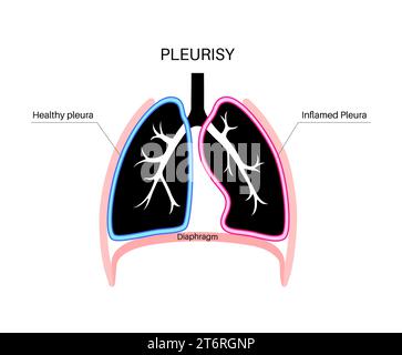 Pleuritis, Illustration Stockfoto