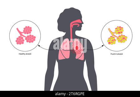 Pneumonie, Illustration Stockfoto